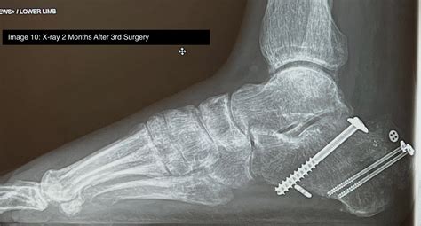 Tongue Type Calcaneal Fracture Image Annotated Jetem