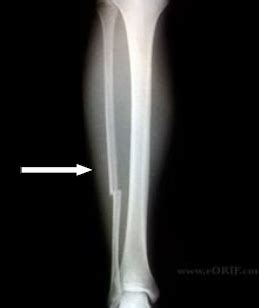 Fibula shaft fracture | CUH