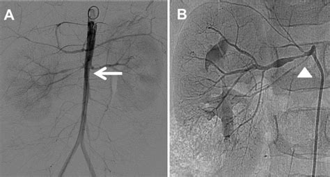 Abdominal Aortography And Renal Angiography A This Abdominal Download Scientific Diagram