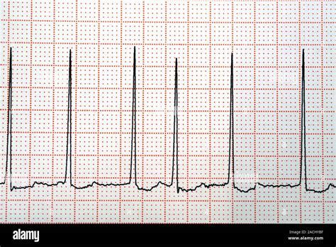 Ecocardiograma Ecg Mostrando La Fibrilación Atrial Fa De Los Latidos Del Corazón Y La