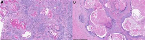 Photomicrographs Of Punch Biopsy Specimens From The Mass A Nests Of