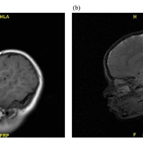 A And B Magnetic Resonant Imaging On Head And Neck Showing Right