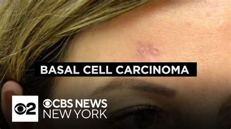 Dermatologist Explains The Dangers Of Basal Cell Carcinoma What To