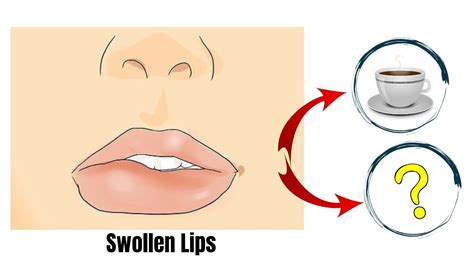 Swollen Lips One Side