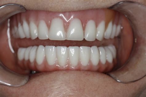 Dental Implants Used To Replace Lower Dentures Fixed Dental Hybrid