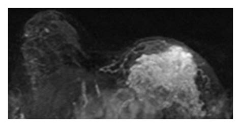 A Year Old Patient With Non Mass Like Enhancement Lesion In The Left