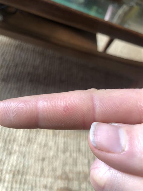 red raised spot, white center, on finger : r/DermatologyQuestions