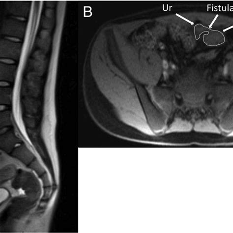 An Abdominal And Pelvic Mri Demonstrating The Urachal Remnant And Cyst