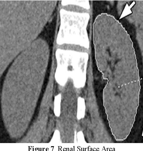 Figure 1 From Measurement Of Renal Dimensions To Determine Standard