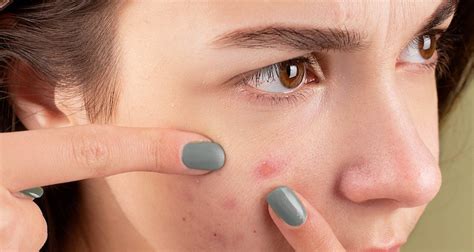 Everything About Cystic Acne Causes Symptoms And Treatment The