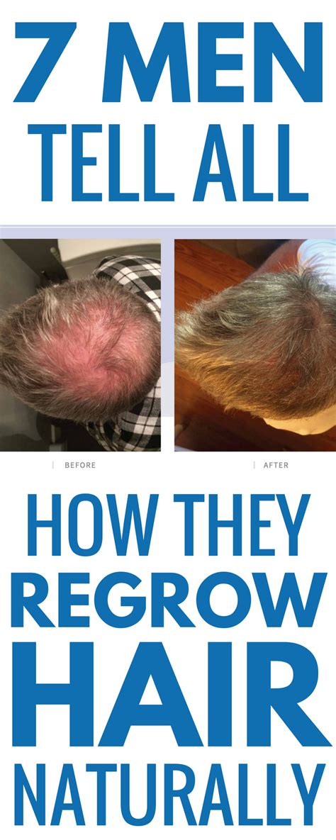 Before And After Pics 2 Products Uses To Regrow Hair For Men Regrow Hair Regrow Hair Men