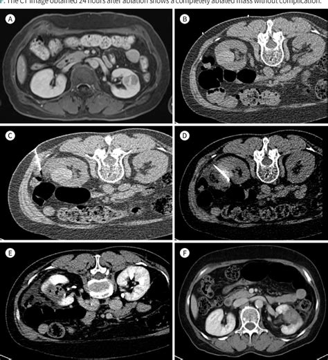 Figure 1 From Imaging Guided Biopsy Percutaneous Ablation And Active