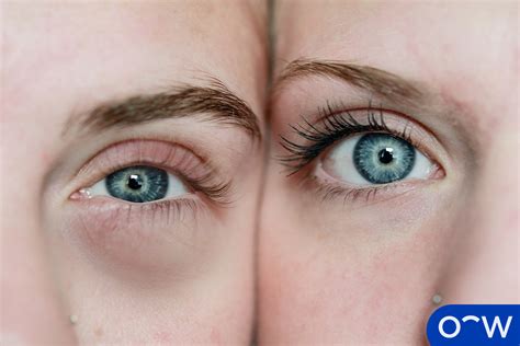 Puffy Eyes Definition Causes Symptoms And Treatment