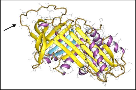 Alpha 1 Antitrypsin Deficiency Pathogenesis Clinical Presentation