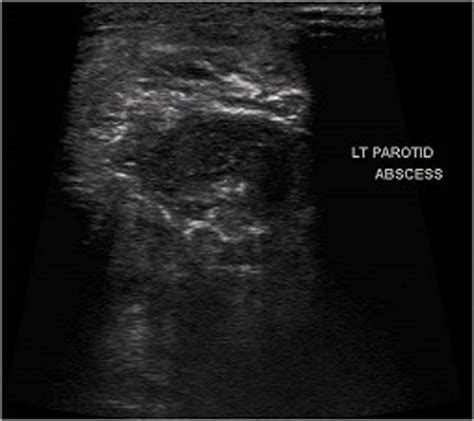 Ultrasound Of Parotid Region On Left Side Showing Ill Defined Download Scientific Diagram