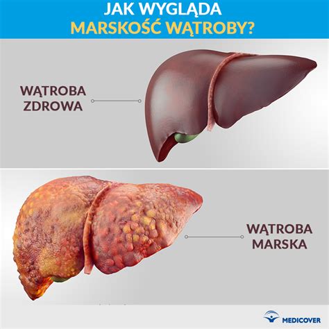 Marskość wątroby Objawy i rokowania przy marskości wątroby