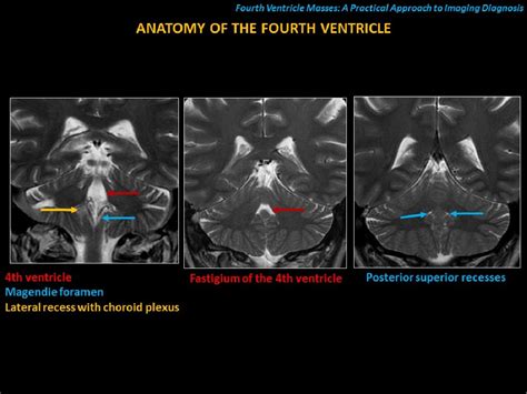 Fourth Ventricle Masses A Practical Approach To Imaging Diagnosis Semantic Scholar