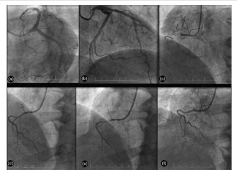 Figure 1 From Pathophysiology And ECG Patterns Of Isolated Right