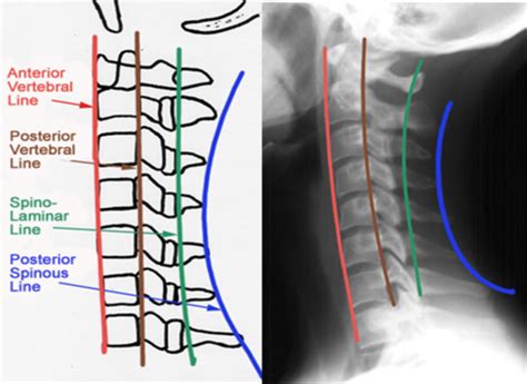 Ana Spine Imaging Flashcards Quizlet