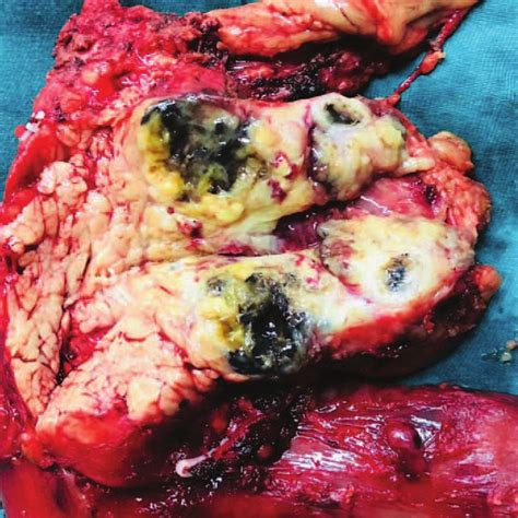 The Macroscopic Image Of Resected Tumor Specimen Indicated A Metastatic