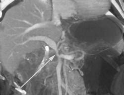 Cm Pancreatic Cancer Encases The Portal Vein And Superior Mesenteric