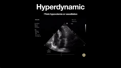 Hyperdynamic Left Ventricle Apical Youtube