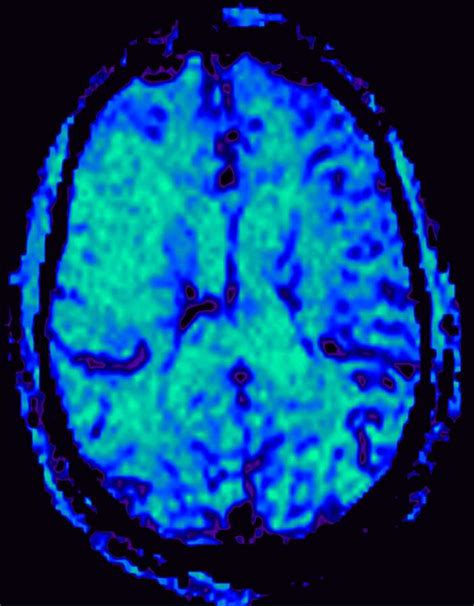 Acute Right Mca Infarct Neuro Mr Case Studies Ctisus Ct Scanning