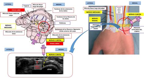 BLOQUEO DEL NERVIO CUBITAL EN LA MUÑECA Dolopedia 10000 Hot Sex Picture