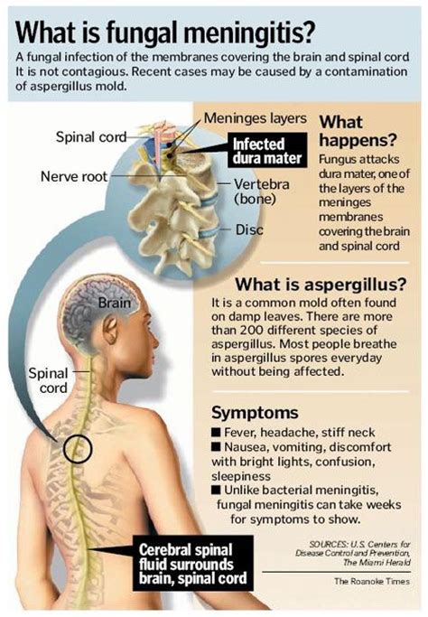 Meningitis Symptoms Artofit