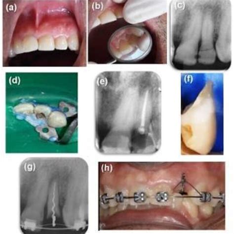 A Buccal View Of The Maxillary Left Lateral Incisor Day After The