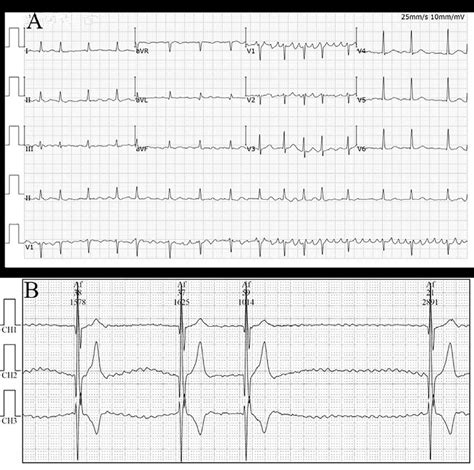 Electrocardiogram Of Case Picture A Showed Atrial Fibrillation