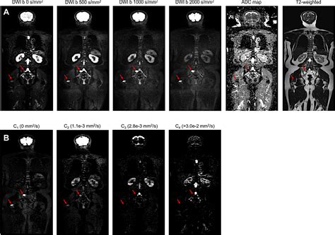 A Multicompartmental Diffusion Model For Improved Assessment Of Whole