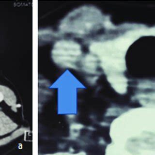 CECT axial section at various levels. (a) Right common carotid artery ...