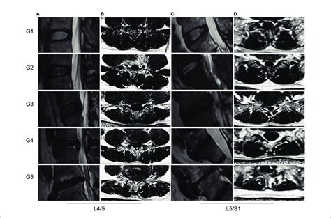 | MRI PDFF of lumbar paraspinal muscles at different Pfirrmann grade of ...