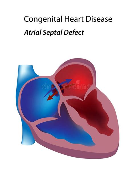 Congenital Heart Disease Diagram