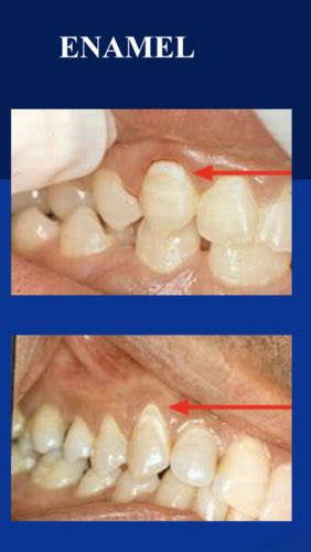 Preventive Lecture 2 Diagnosis Of Caries Flashcards Quizlet