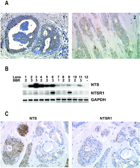 Neurotensin Expression In Idcs A Nts Immunohistochemistry Was