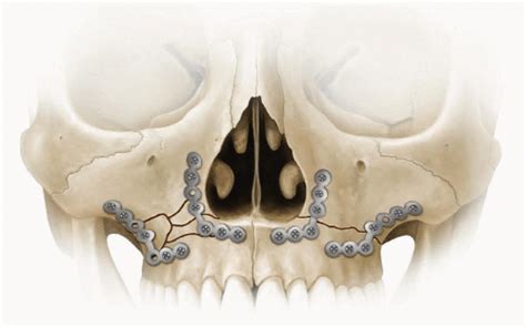 Correction of Le Fort I Fracture | Plastic Surgery Key