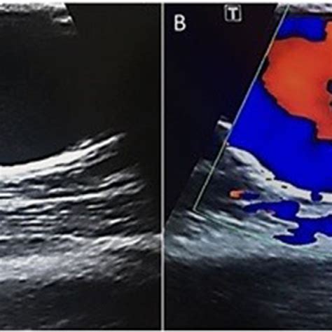 -Grayscale (A) and color Doppler (B) ultrasound of the basilic vein ...