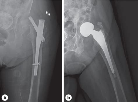 outcomes  subcapital femoral fracture   fixation