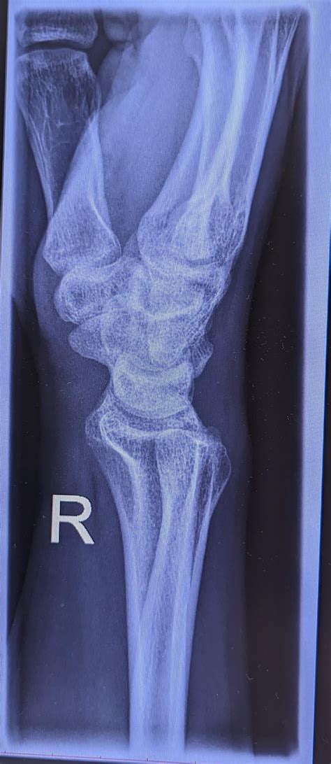 M 21 with sudden wristpain and palmary ganglia : r/Radiology