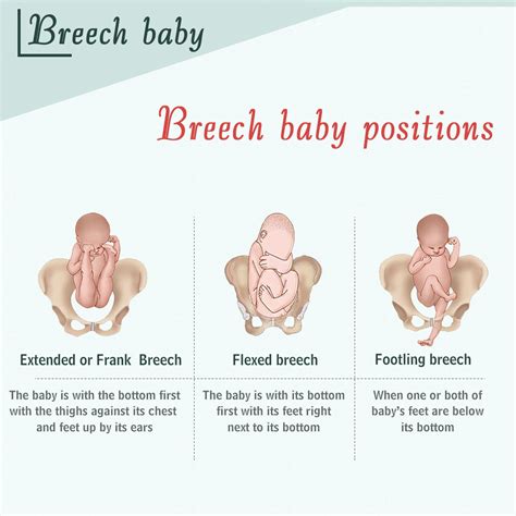 Breech Baby and External Cephalic Version – Dr. Deepika Aggarwal – a ...