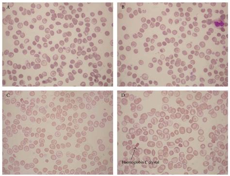 Hemoglobin Sc Disease Blood Smear