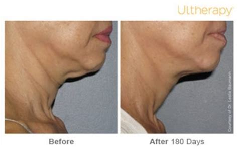 Ultherapy Before And After Photos Mulberry House Clinic