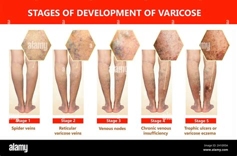 Varicose Veins On A Female Senior Legs The Stages Of Varicose Veins