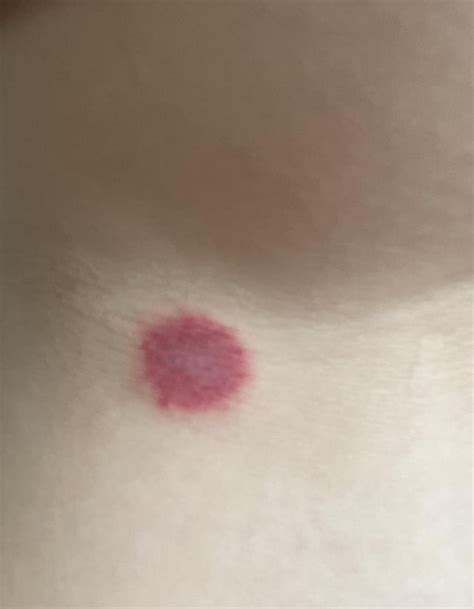 Really red and itchy bump, what could this be? : r/medical