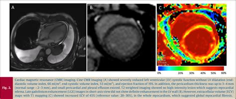 Figure From Assessment Of Myocardial Fibrosis Using T Mapping And