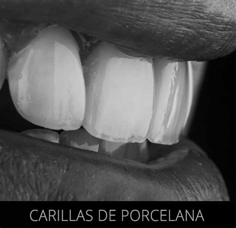 C Mo Se Colocan Las Carillas Dentales Institut Joan Autr N