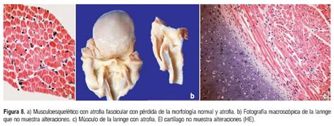 Lactante con atrofia muscular espinal y encefalopatía hipóxico isquémica