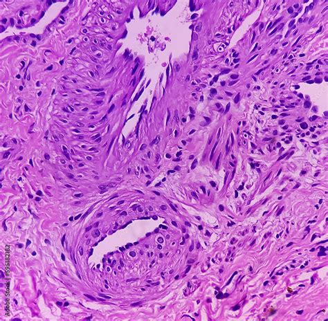 Great Toe Soft Tissue Biopsy Glomus Tumor Or Paragangliomas